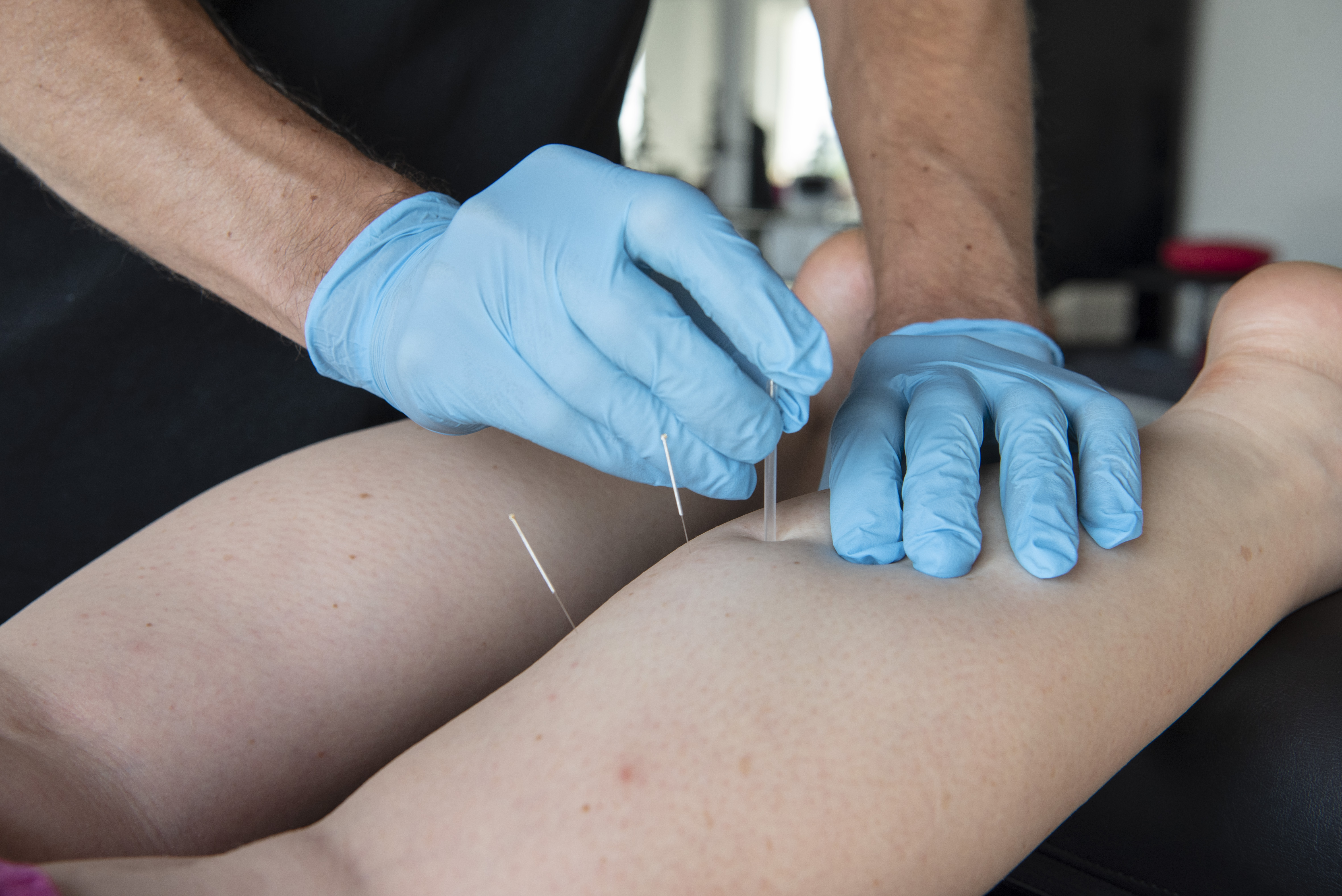 igły do suchego igłowania 