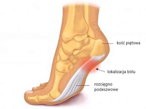 Rozcięgno podeszwowe - ból pięty 