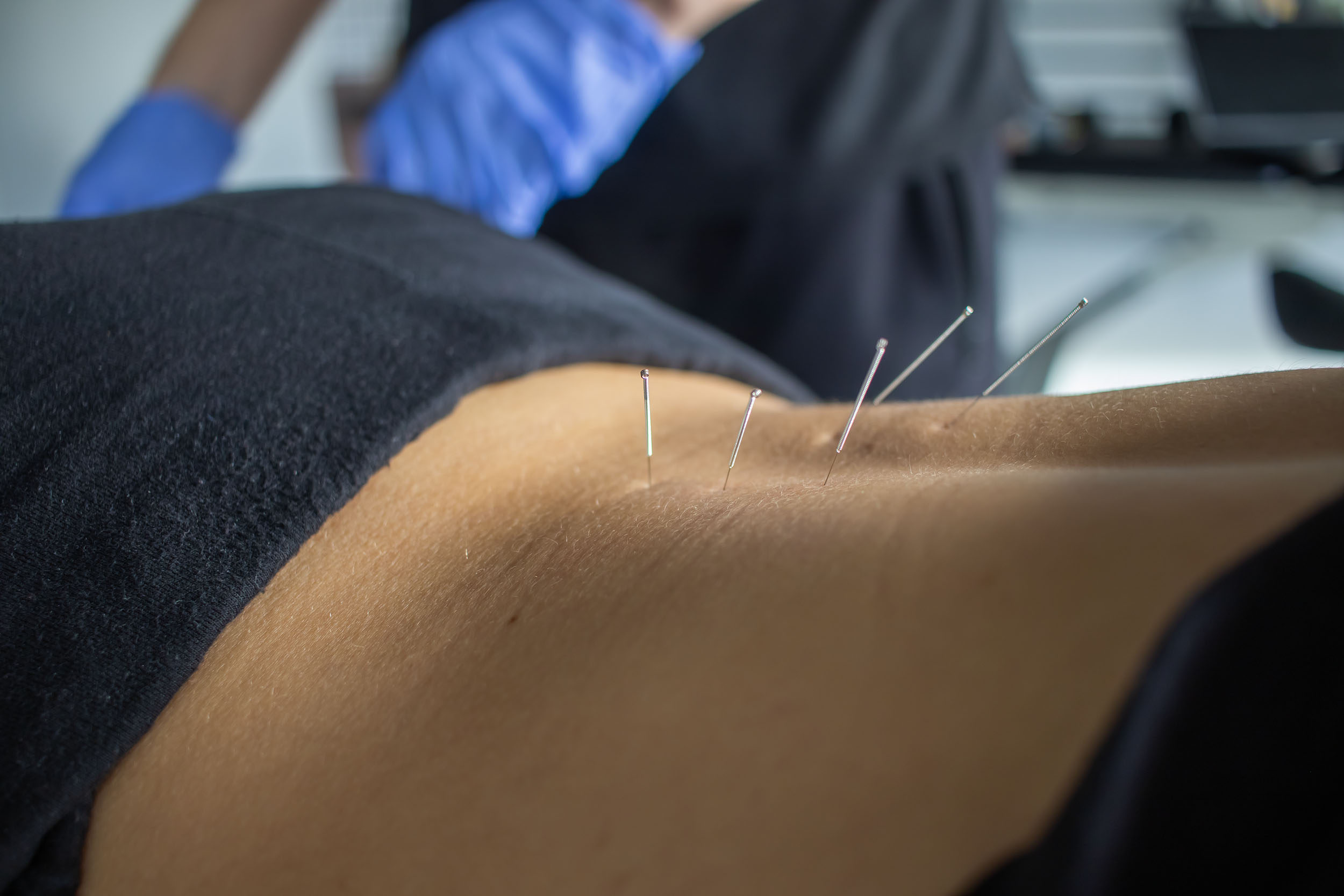 Suche igłowanie w fizjoterapii kręgosłupa 