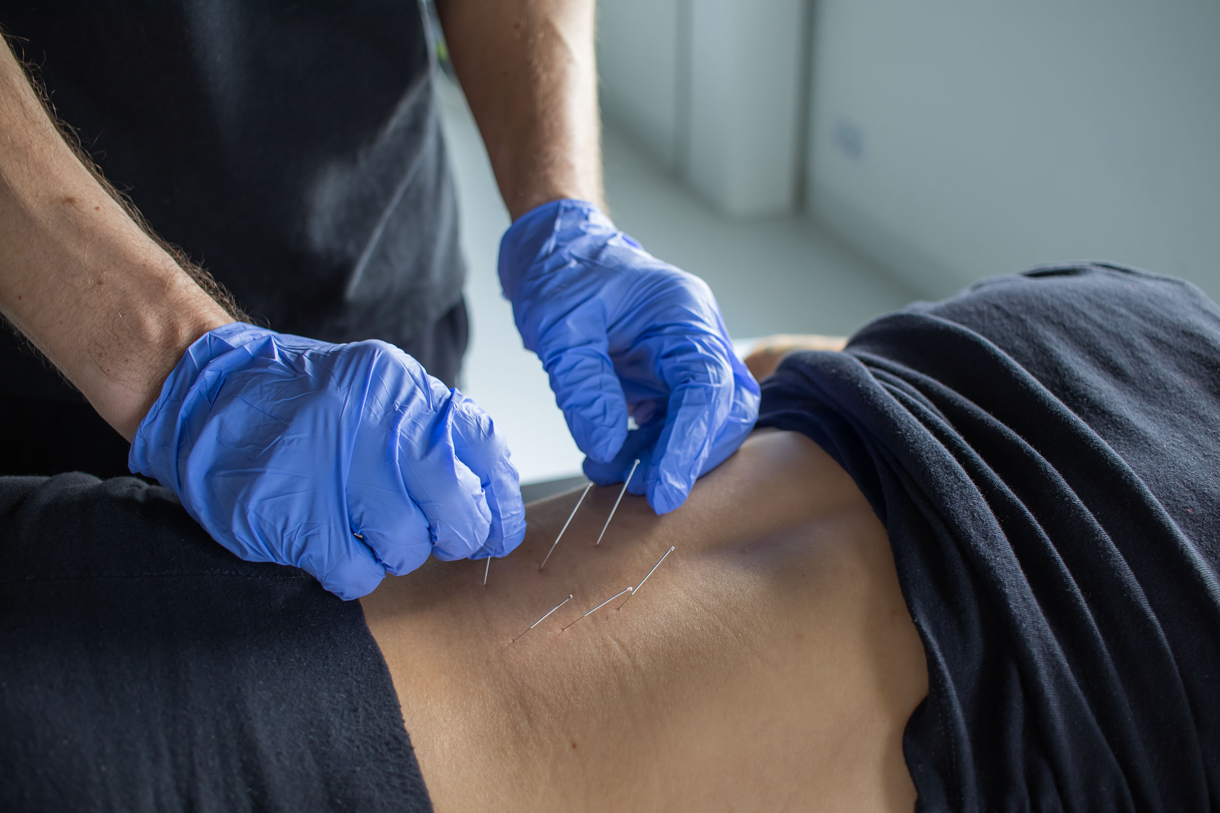 Aplikacja suchego igłowania 