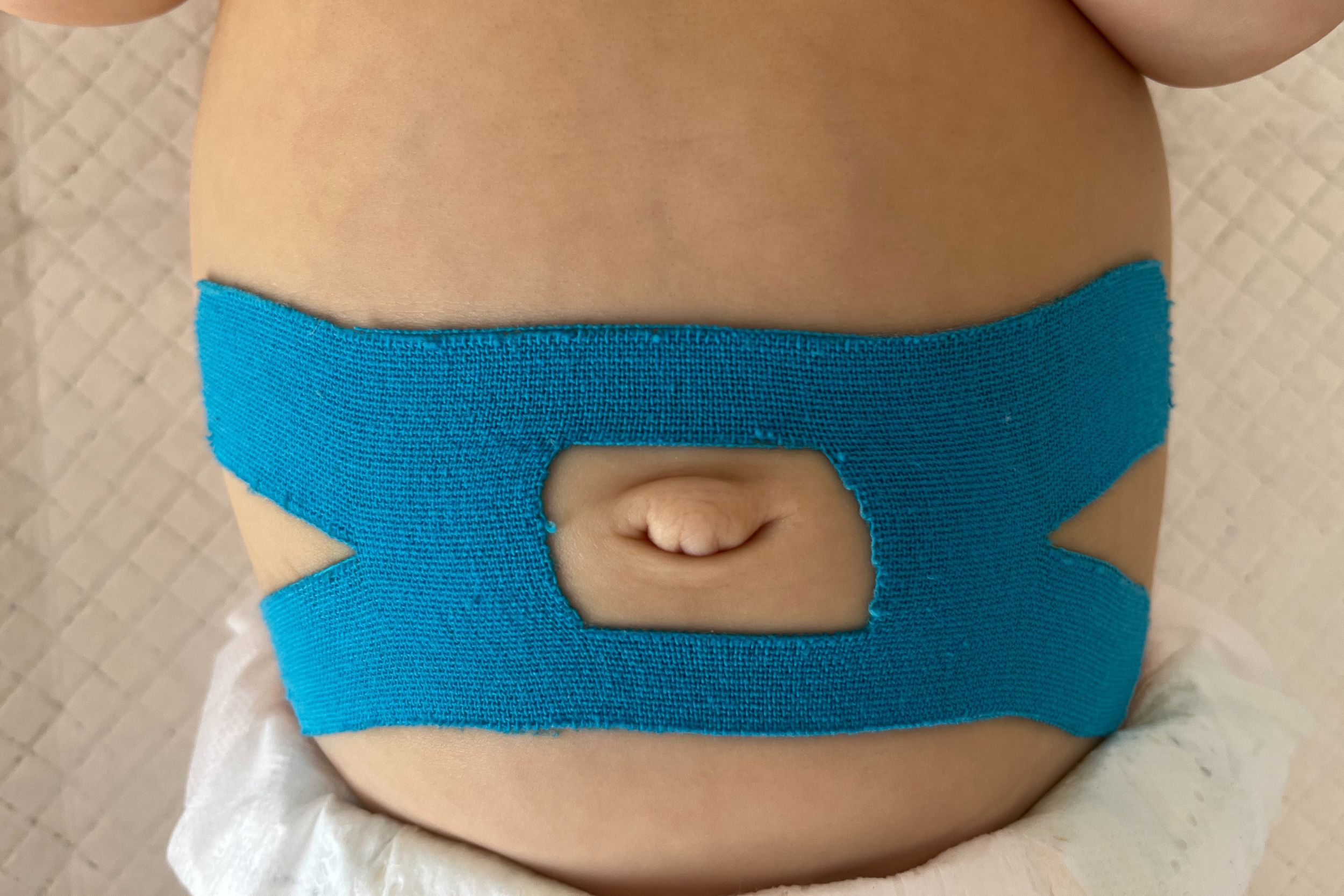 Przepuklina pępkowa, a kinesiotaping przepuklina pępkowa