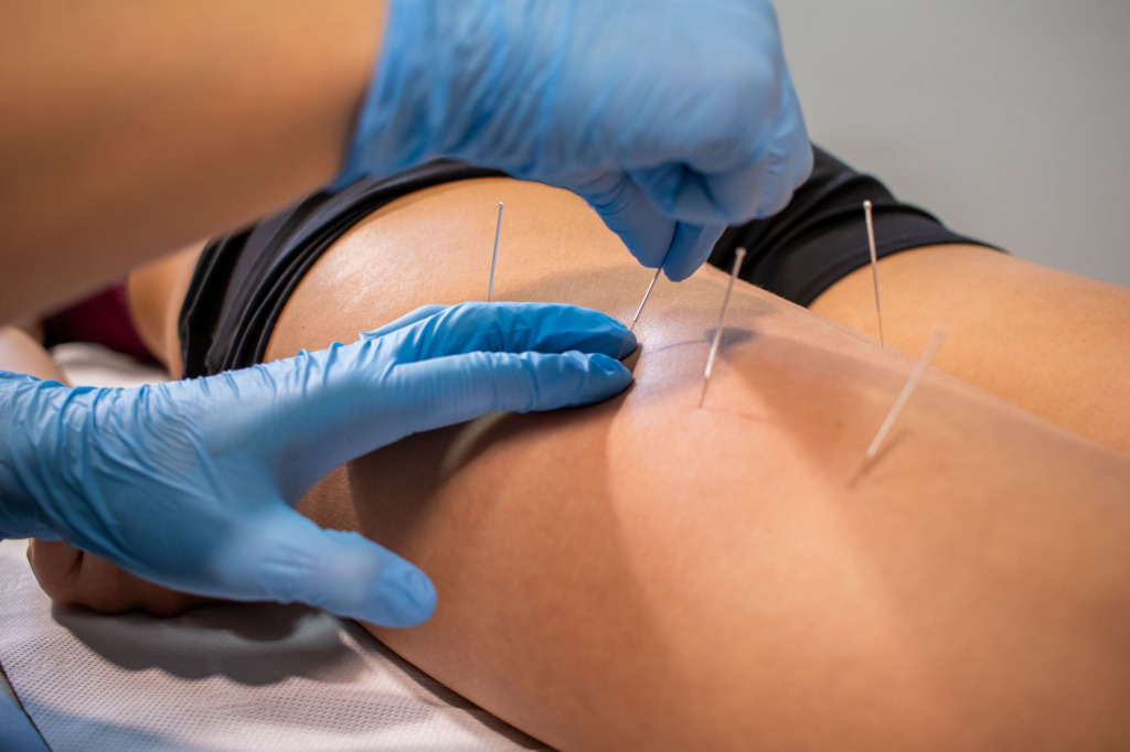 Jak wykonać suche igłowanie? Poradnik na mięśnie przykręgosłupowe i kulszowo - goleniowe