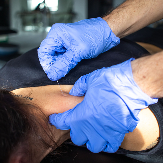 yellowSTING - Igły do suchego igłowania z prowadnicą - 0,25 x 50 mm - 100 szt.