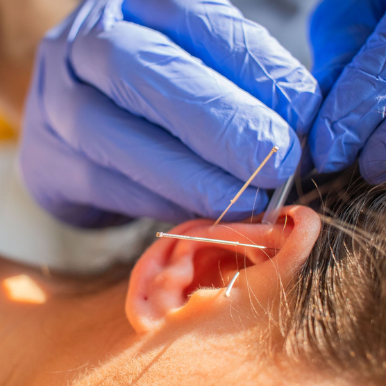 yellowSTING - Igły do suchego igłowania z prowadnicą - 0,30 x 30 mm - 100 szt.