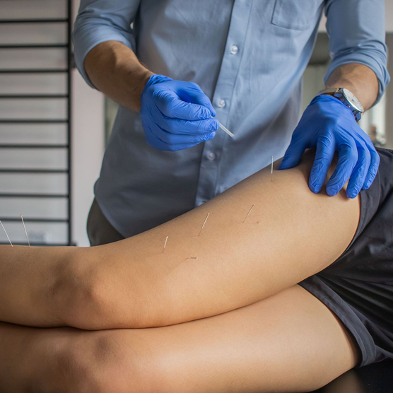 yellowSTING - Igły do suchego igłowania z prowadnicą - 0,30 x 30 mm - 100 szt.